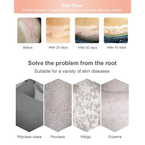 Lámpara UV de 311 nm para Tratar Vitiligo y Psoriasis