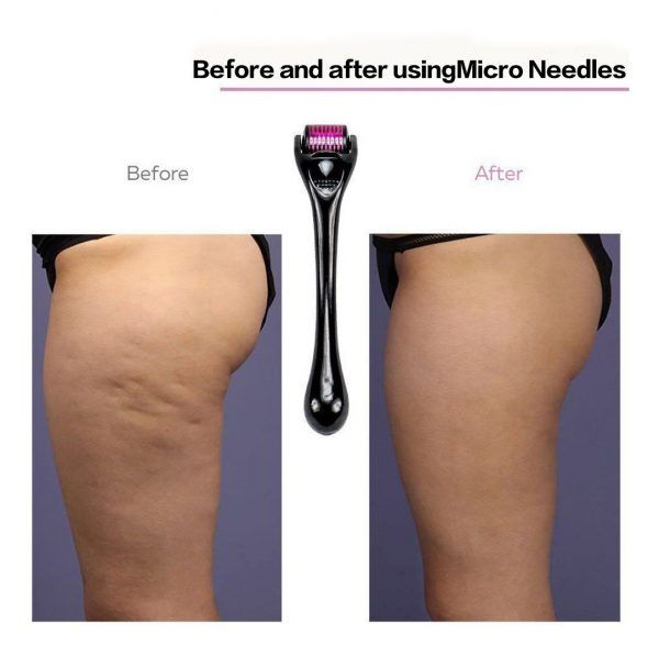 Derma Roller 0.5 mm – Inductor de Colágeno Percutáneo