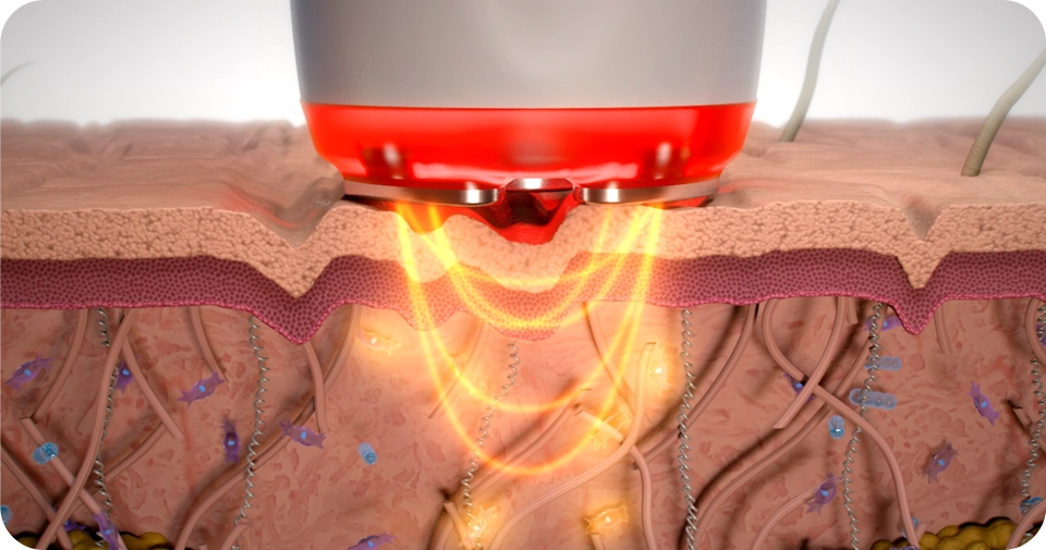 Combinado profesional radiofrecuencia, electroporador, crioterapia y termoterapia